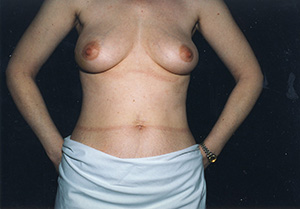 Breast Reconstruction 4a